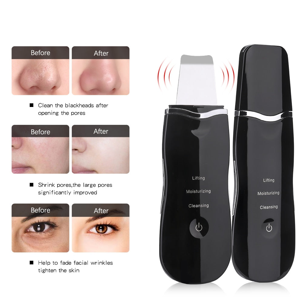 Vibration Ultrasonic Skin Scrubber Blackhead Facial Remover