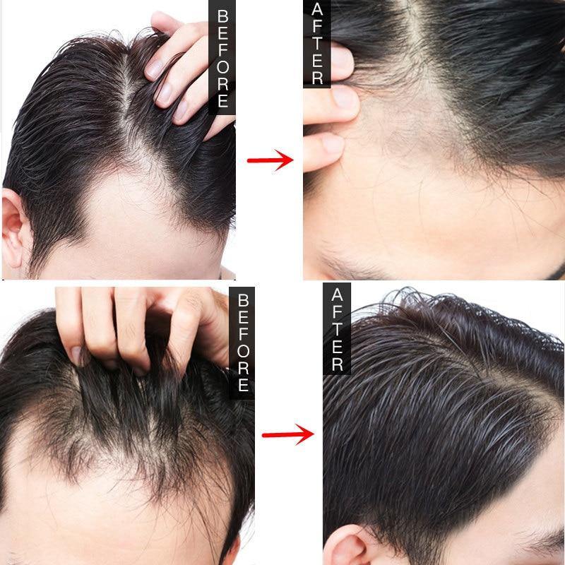 Women Men Herbal Hair Growth Essence Anti Hair Loss Liquid Promote Thick Fast Hair Growth Treatment Essential Oil Health Care